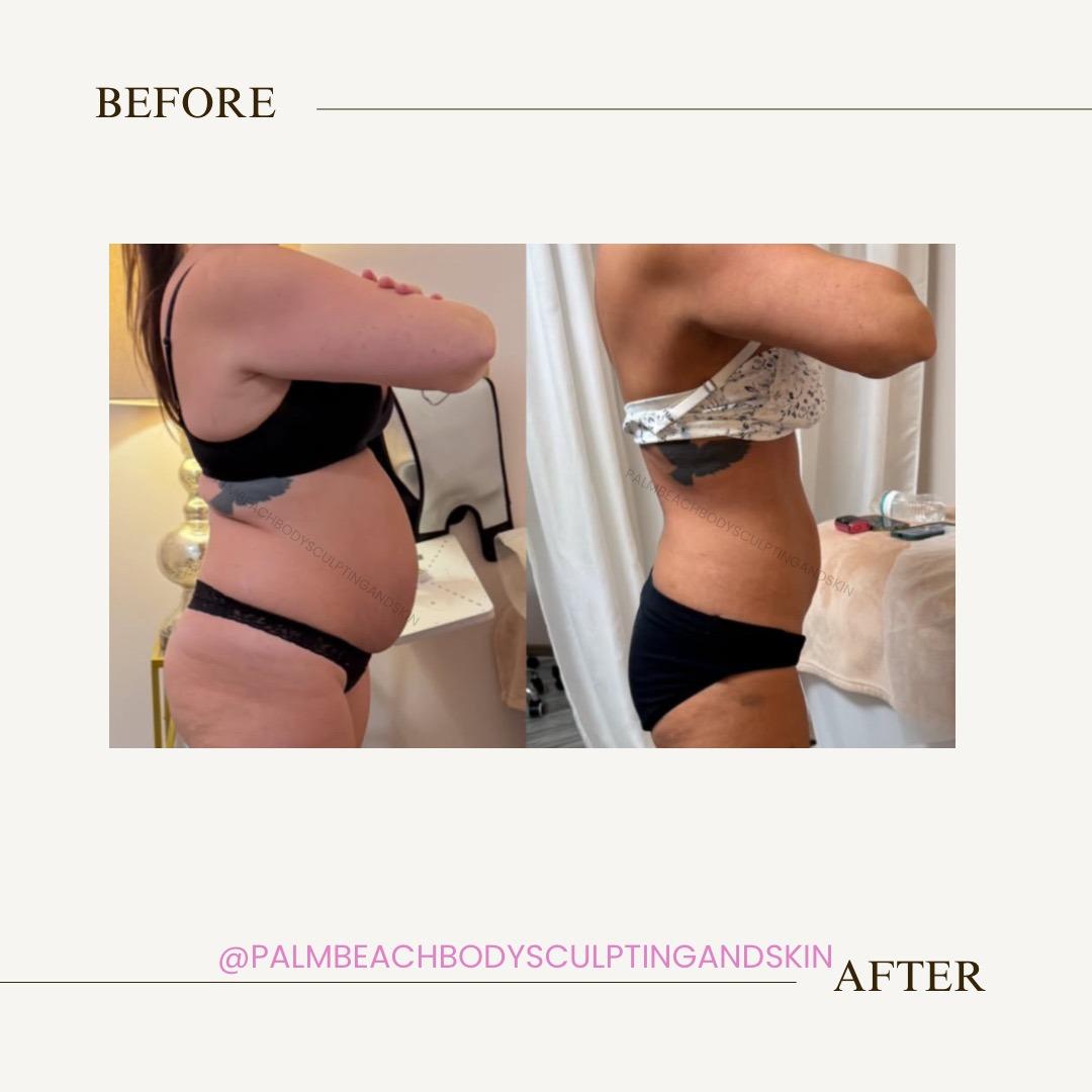 Side-by-side comparison of a woman's abdomen before and after body sculpting treatment