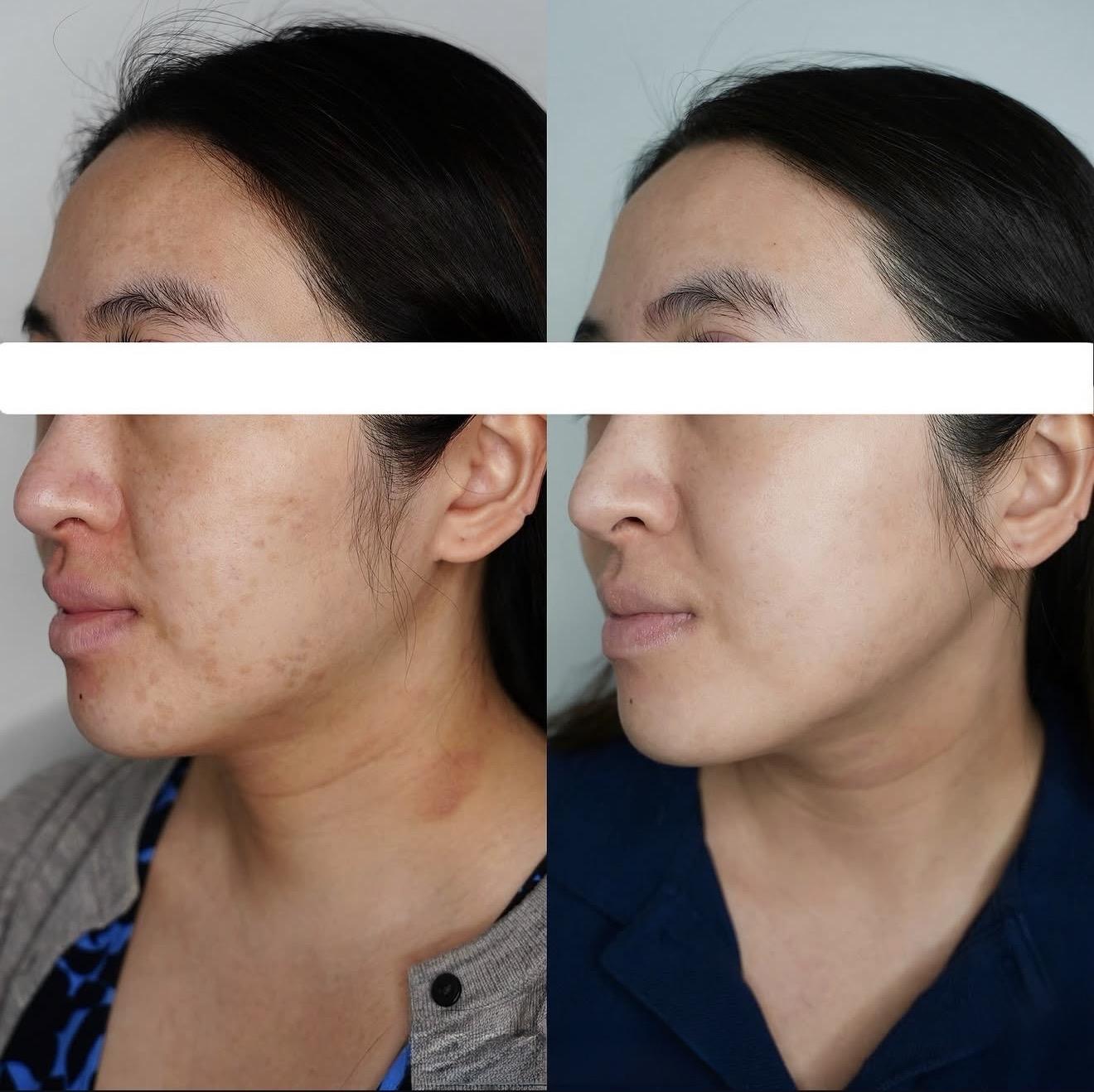 Before and after skin treatment showing significant improvement in complexion and tone