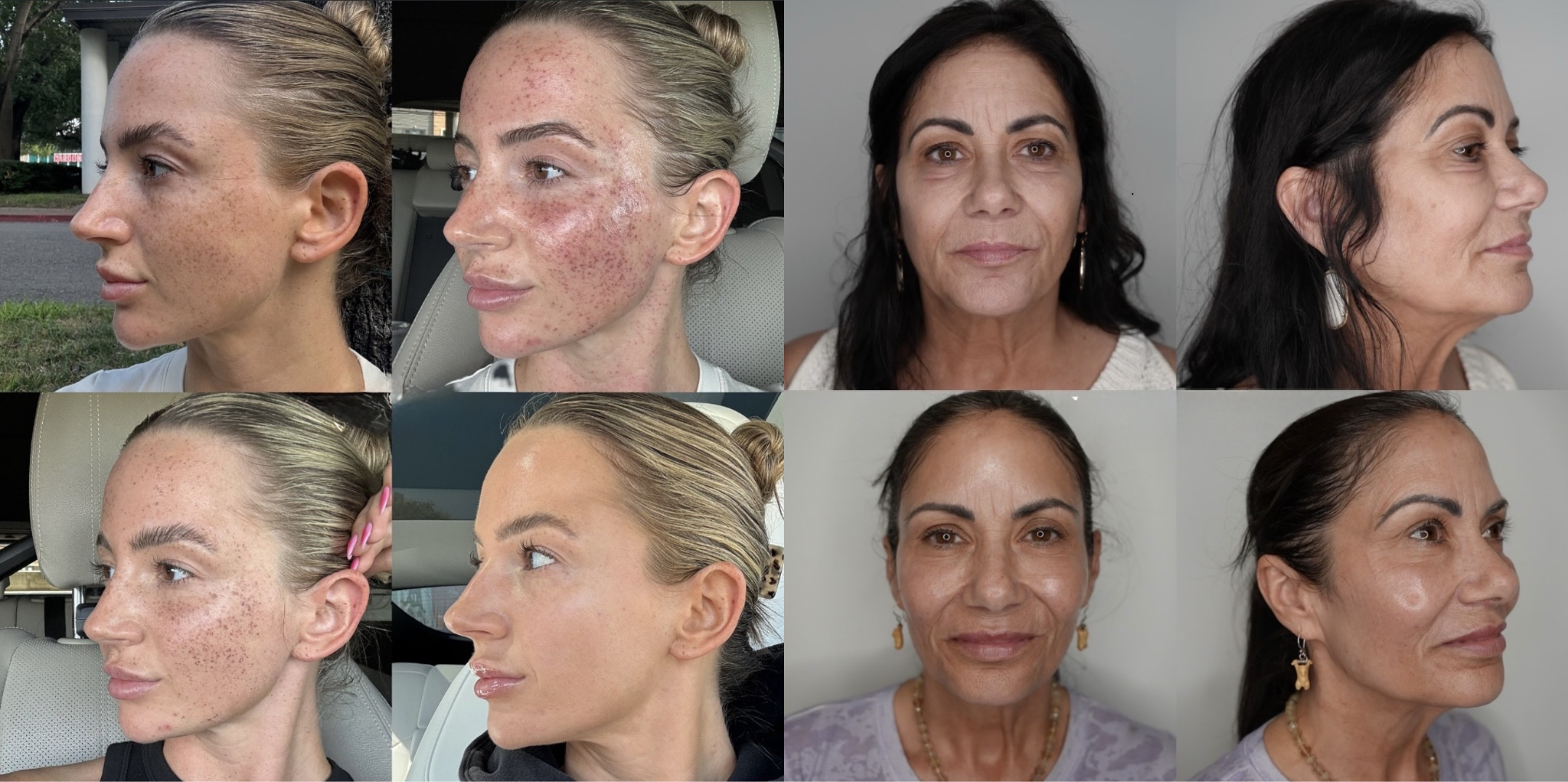 Before-and-after photos of two women showing skin improvements and different angles