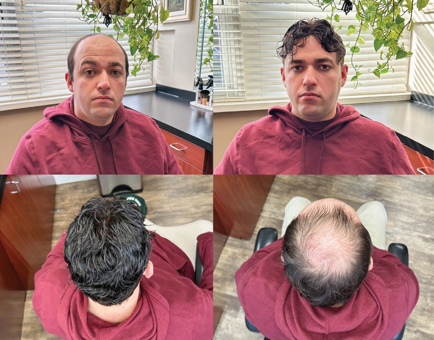 why-non-surgical-hair-replacement-still-matters-in-a-world-of-transplants-.jpeg